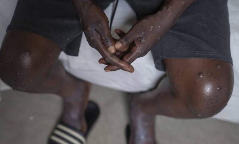 Photo of Cas de variole du singe au Sénégal : Les autorités sanitaires appellent les citoyens à la vigilance